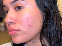 Targeted Spot Solution with Salicylic Acid