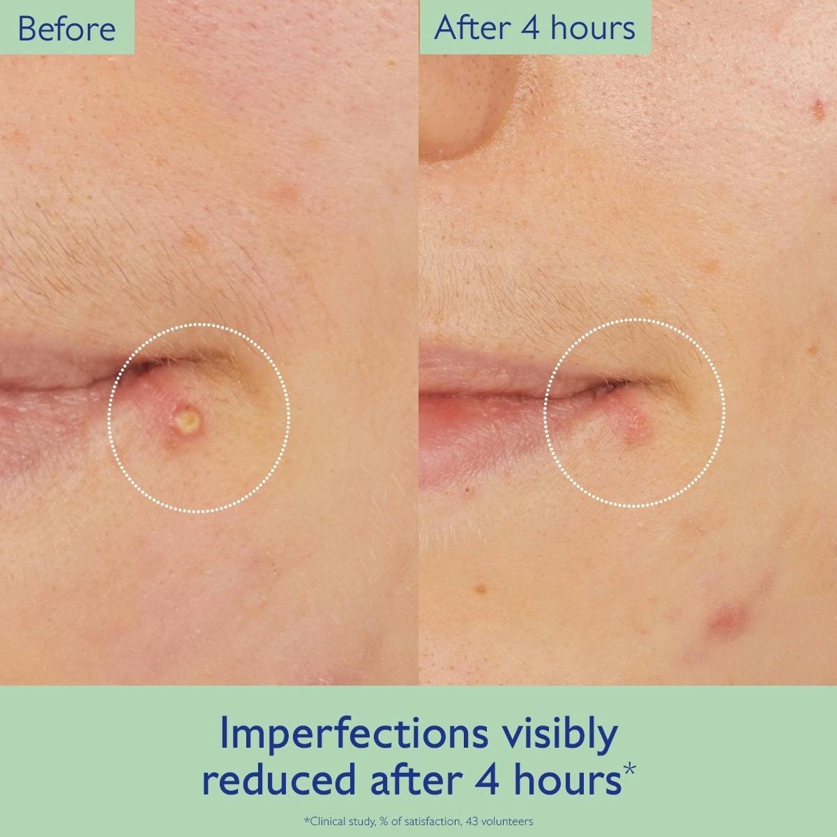 Targeted Spot Solution with Salicylic Acid