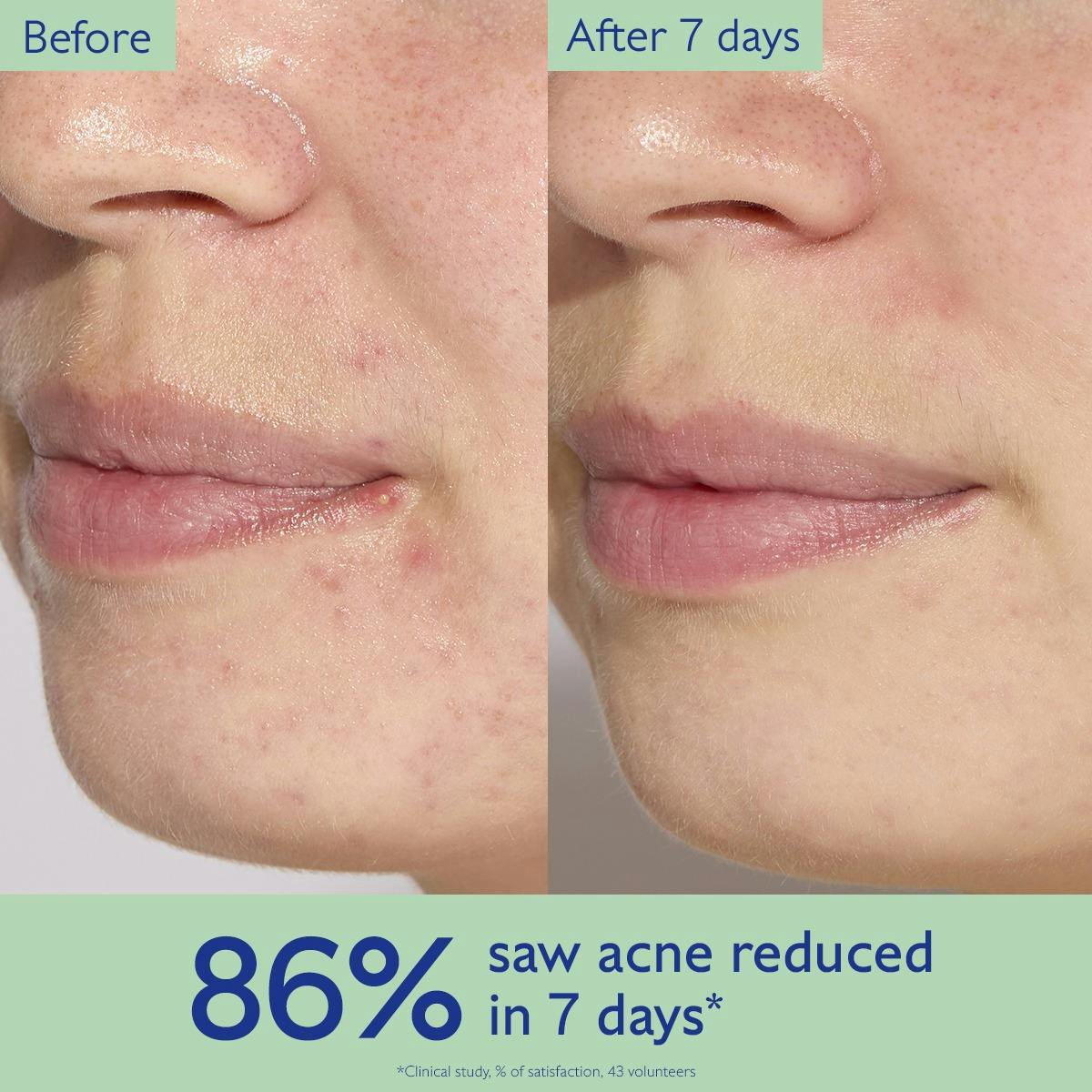 Acne-Prone Skin Trio