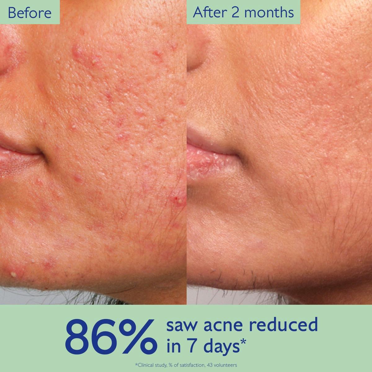 Acne Serum to Treat and Prevent Blemishes