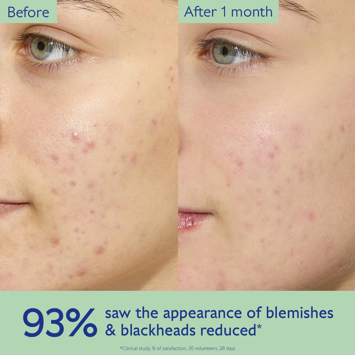 Oil-Control Moisturizer for Acne Prone Skin