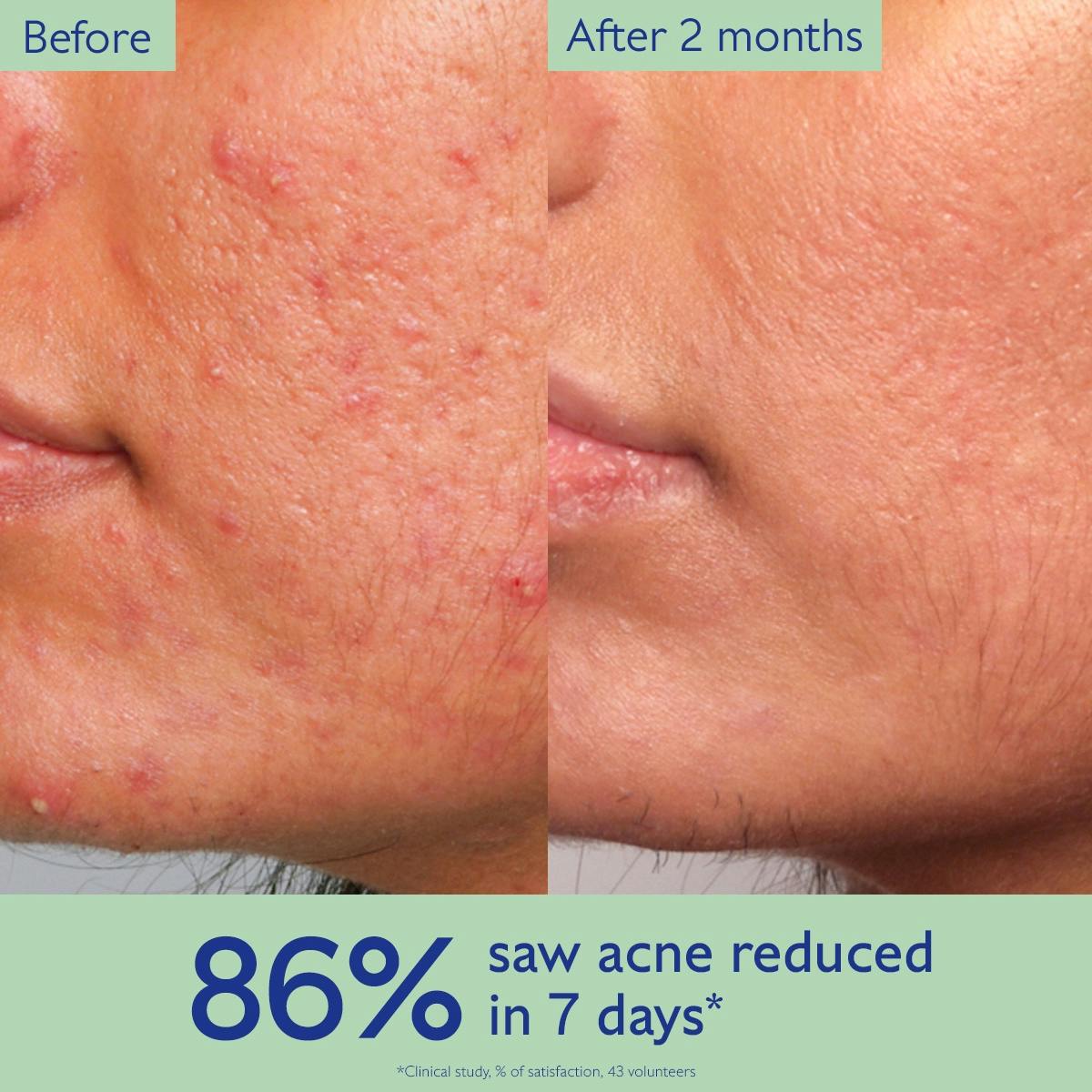 Acne-Prone Skin Essentials