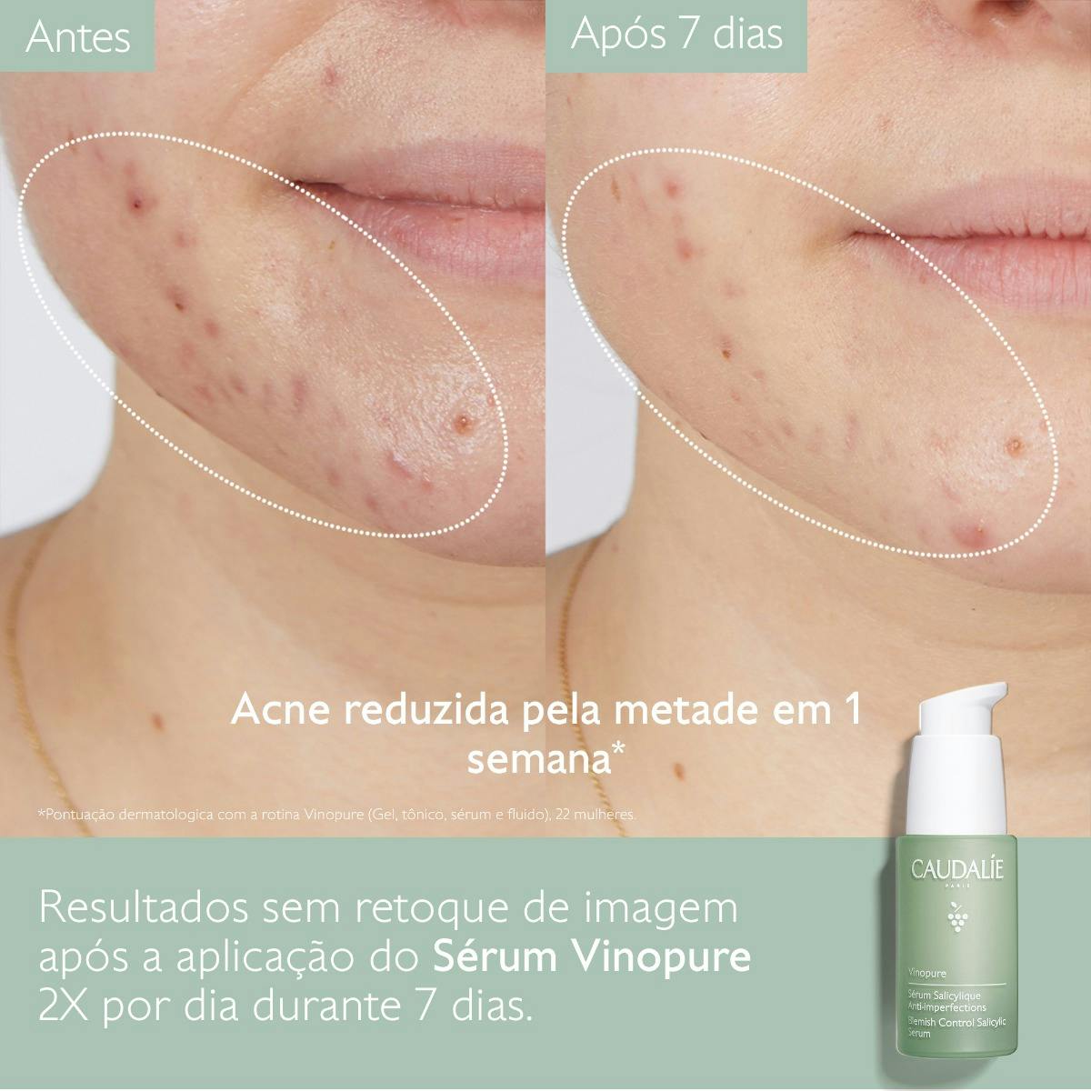 Sérum Salicílico Anti-imperfeições