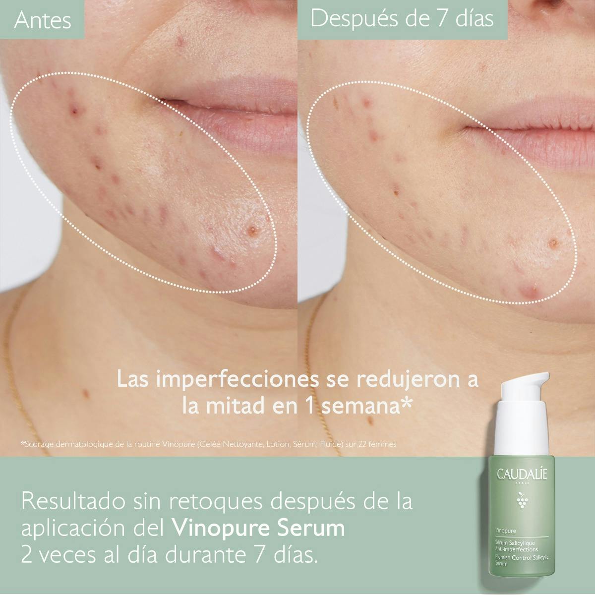 Esenciales para Piel Propensa al Acné