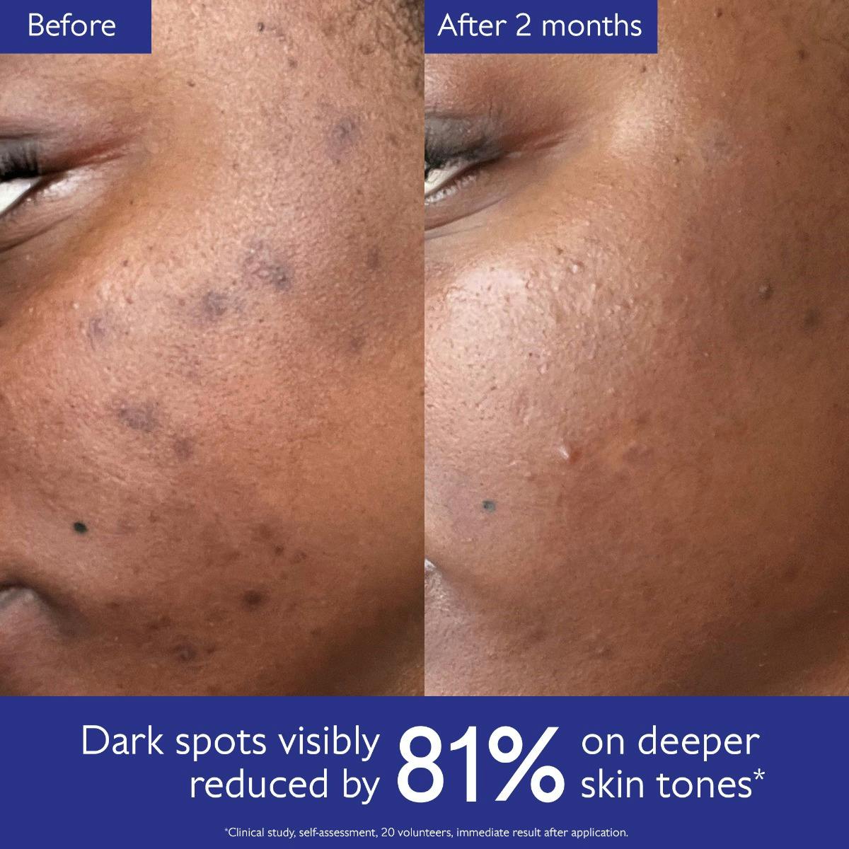 Brightening Dark Spot Serum Vitamin C Alternative