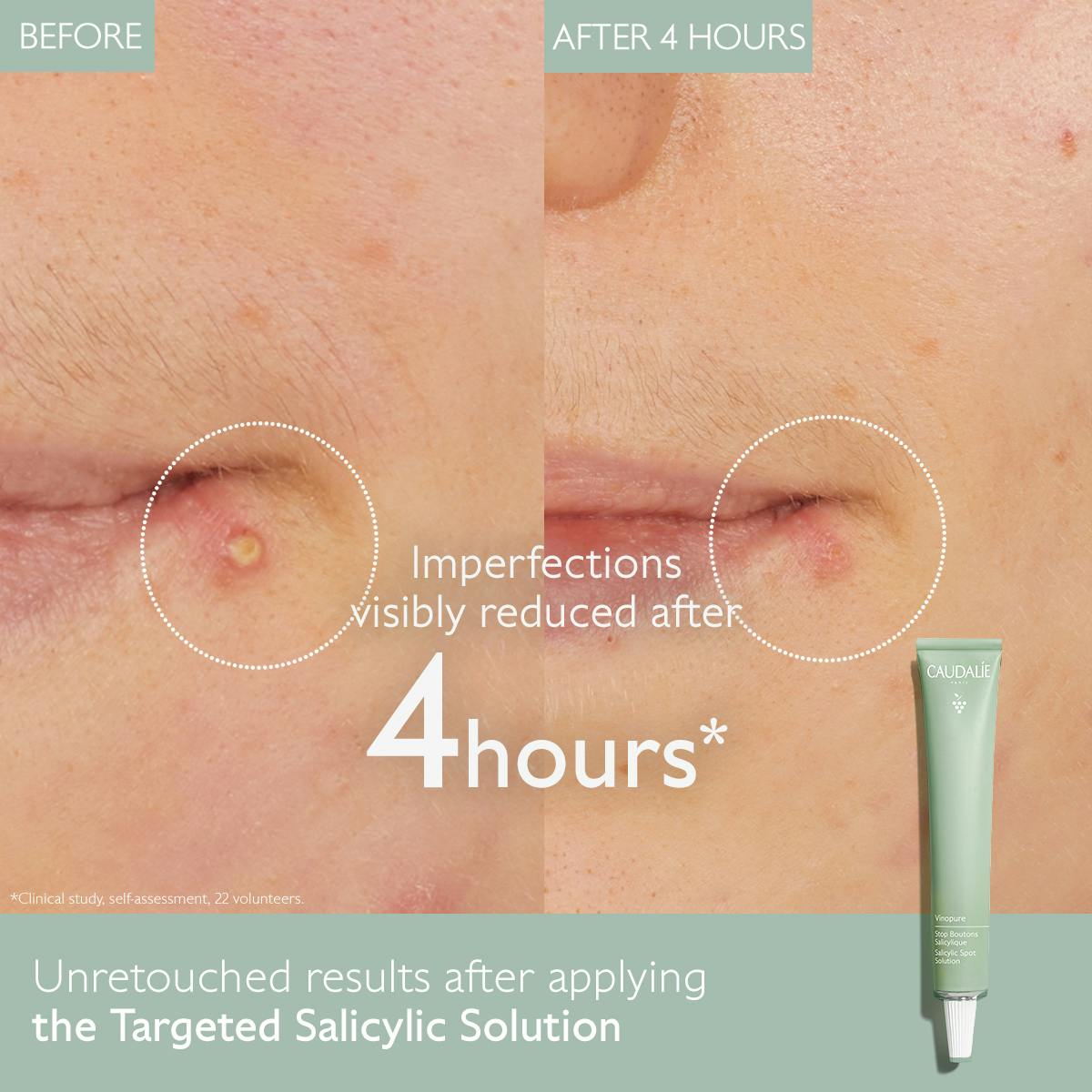 Color Correcting Spot Solution with Salicylic Acid