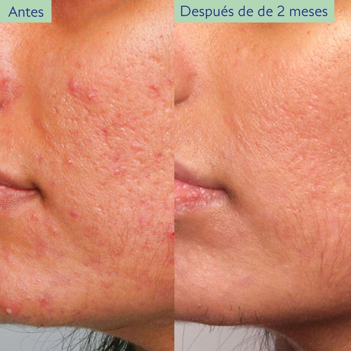 Serum Minimizador del Poro con Ácido Salicílico