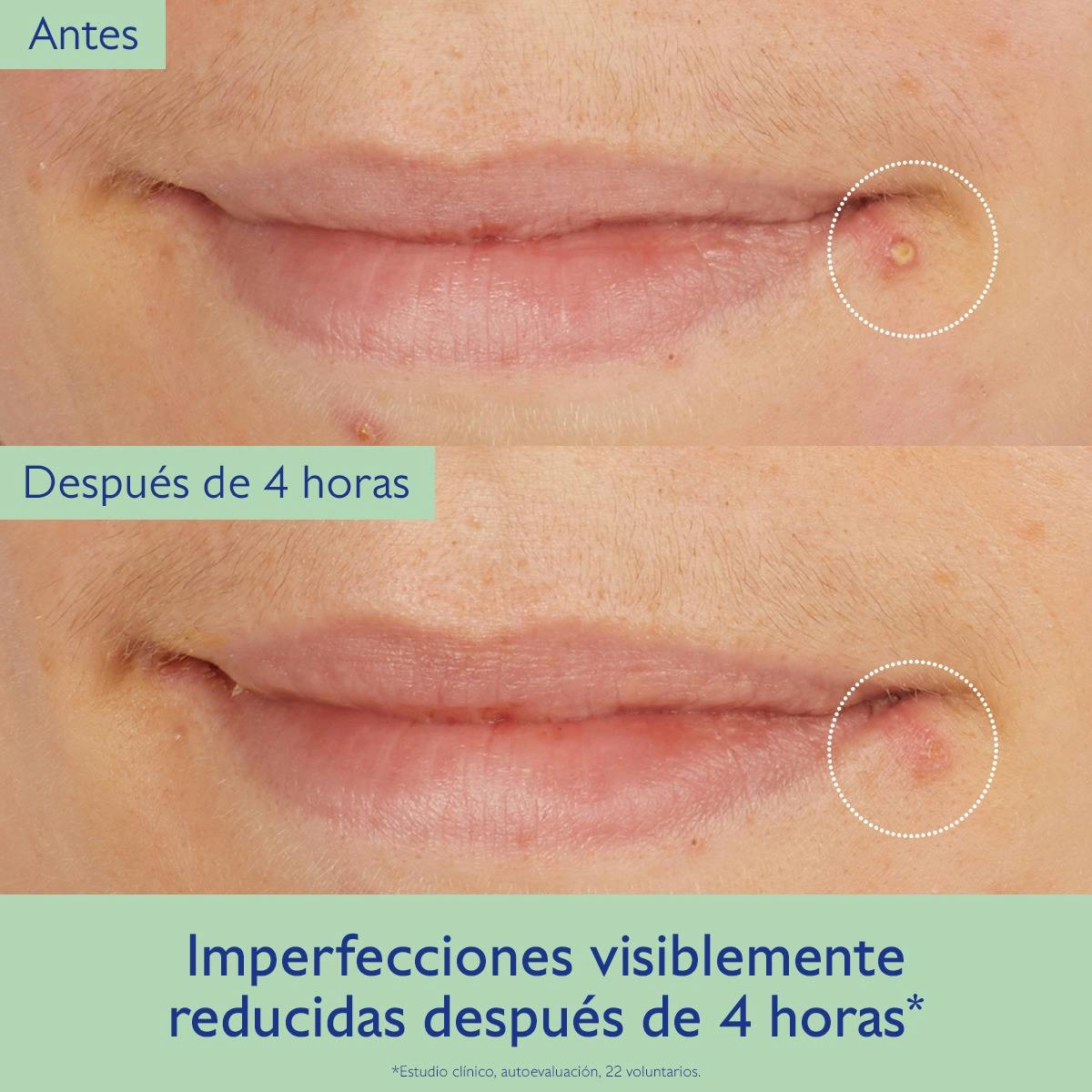 Tratamiento de Ácido Salicīlico Natural