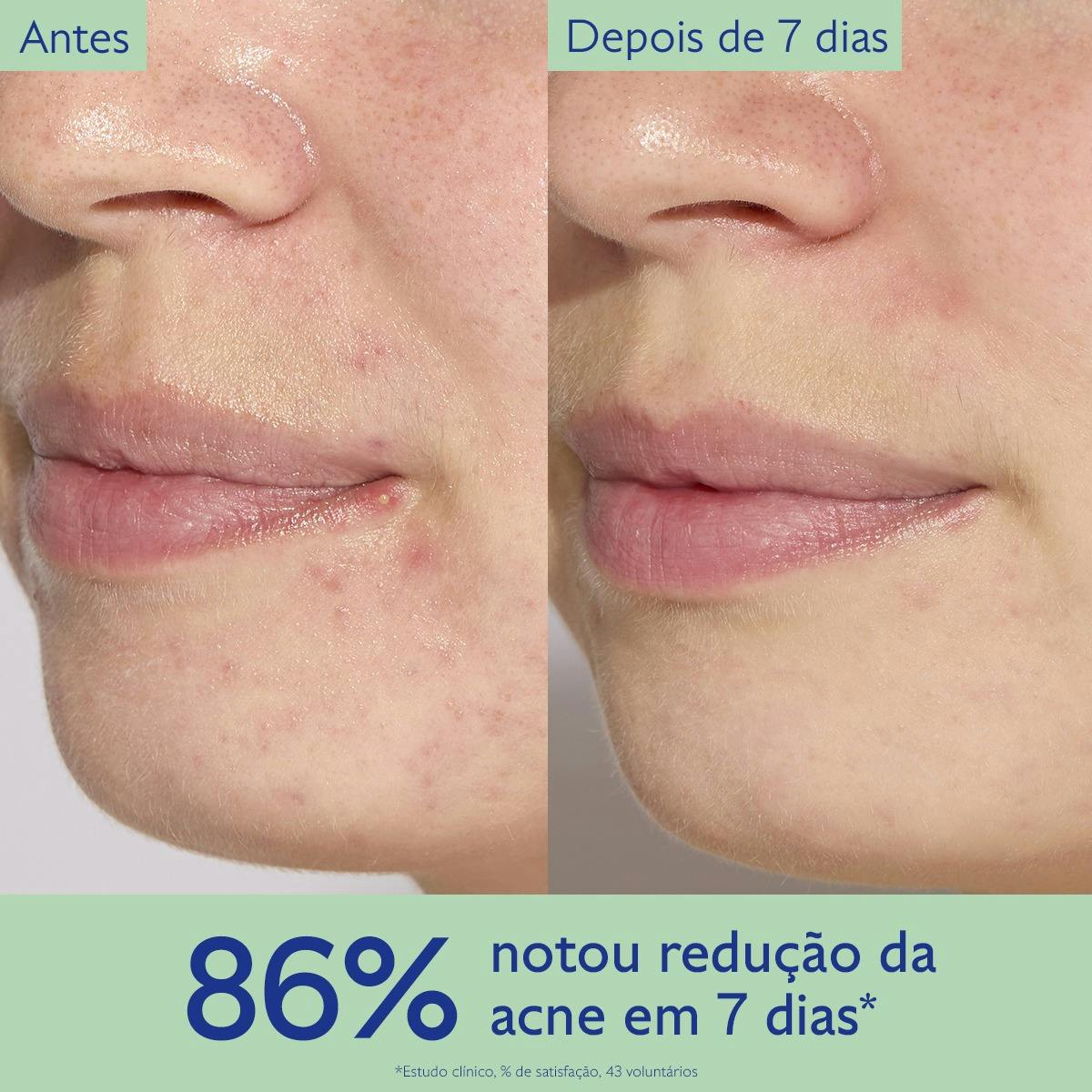 Trio para Peles Acneicas