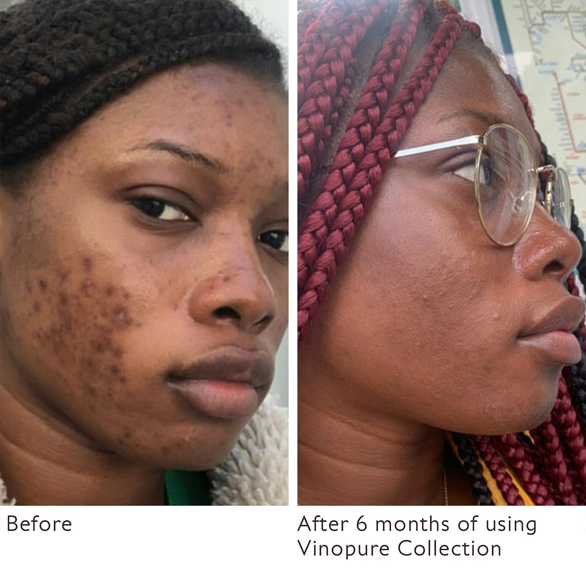 Vinopure Natural Pore Minimizing Salicylic Acid Toner